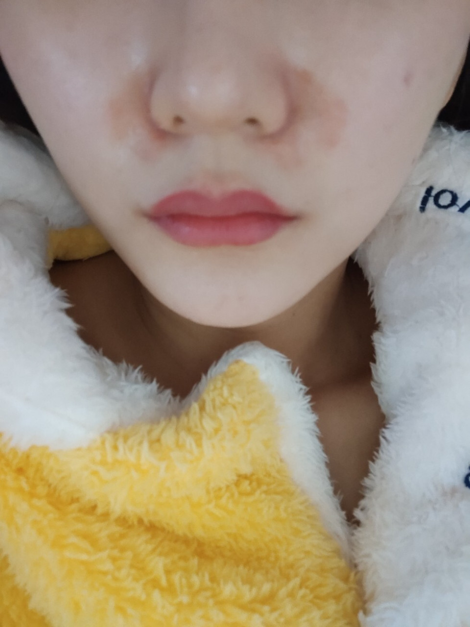 集美们,麻药灼伤了怎么办呀,会不会留痕迹呀,好担心呀,心烦意乱