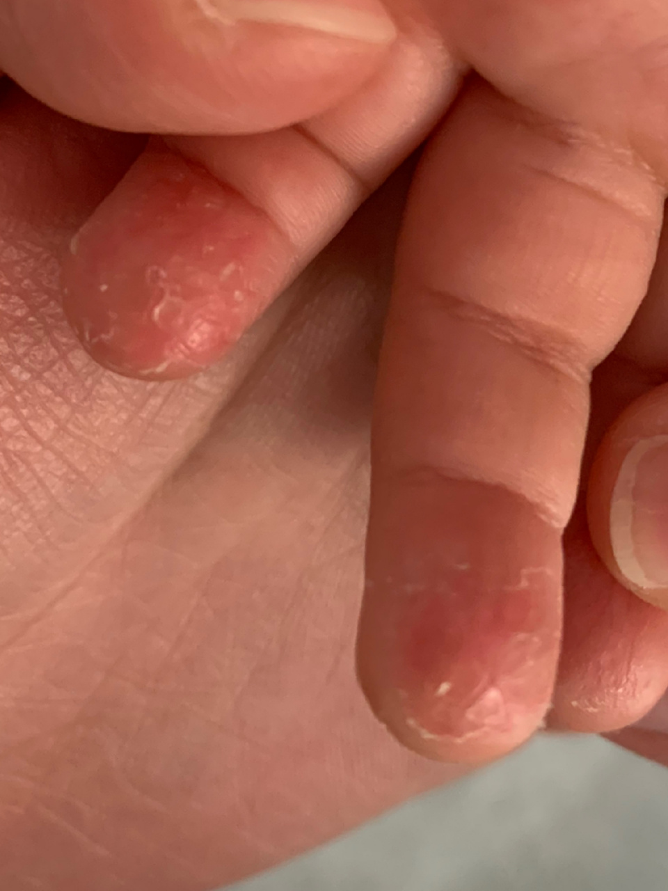 宝宝手心小红点 两岁的娃,手指脱皮,手心红红的,今