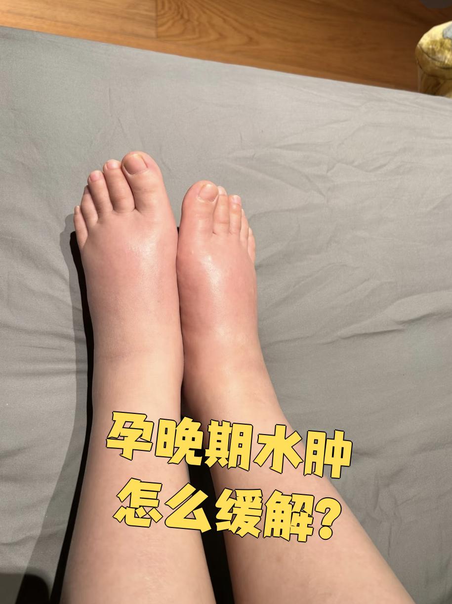 孕晚期水肿很常见,主要是子宫增大压迫血管引起的