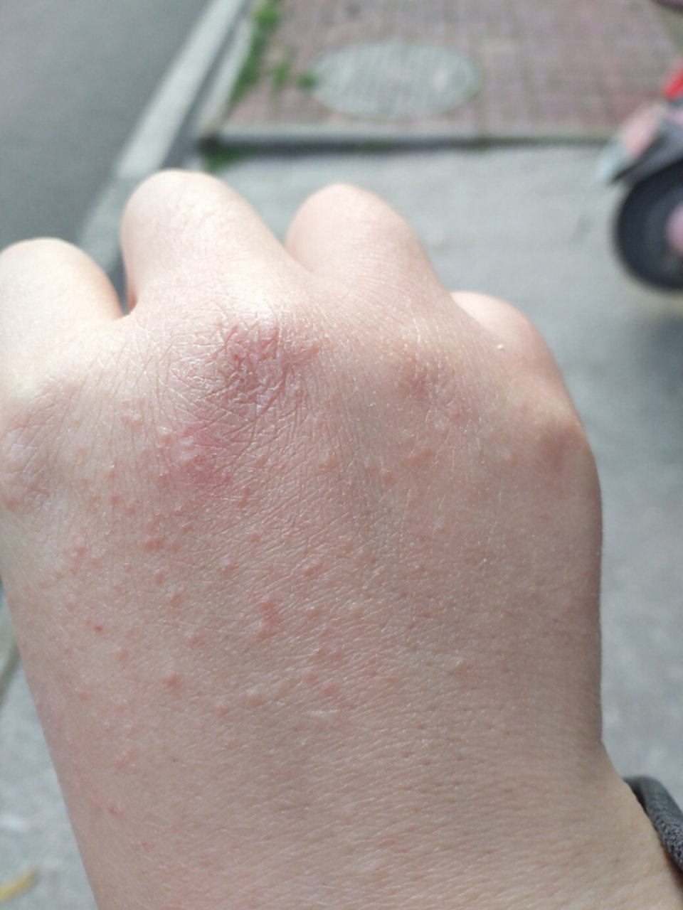 手背上起了些小疙瘩,是什么 最近发现长多了,今天早上醒来有点痒,其他