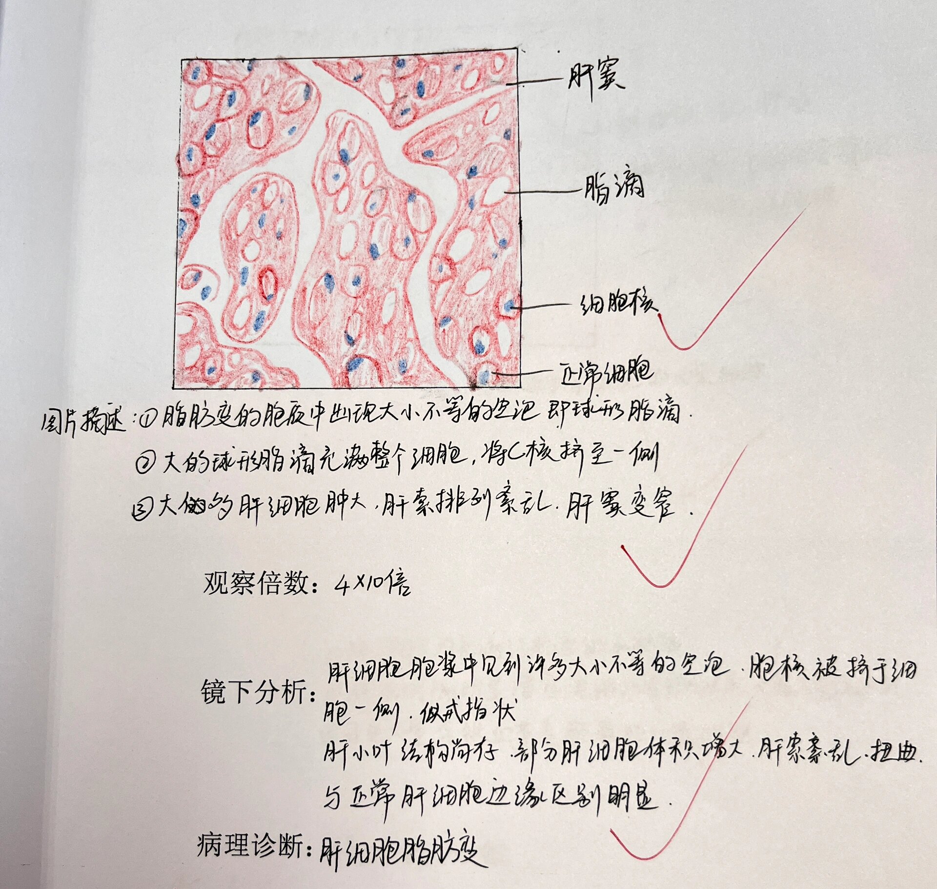 病理肝细胞脂肪变
