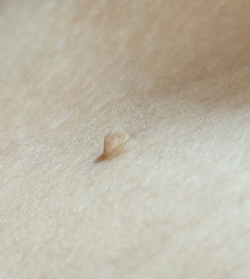 大腿内侧长小肉粒,常见原因包括皮赘,丝状疣和脂肪瘤