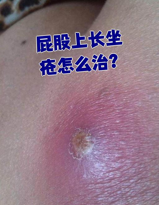 屁股上长坐疮(也叫坐板疮)是细菌感染引起的皮肤病