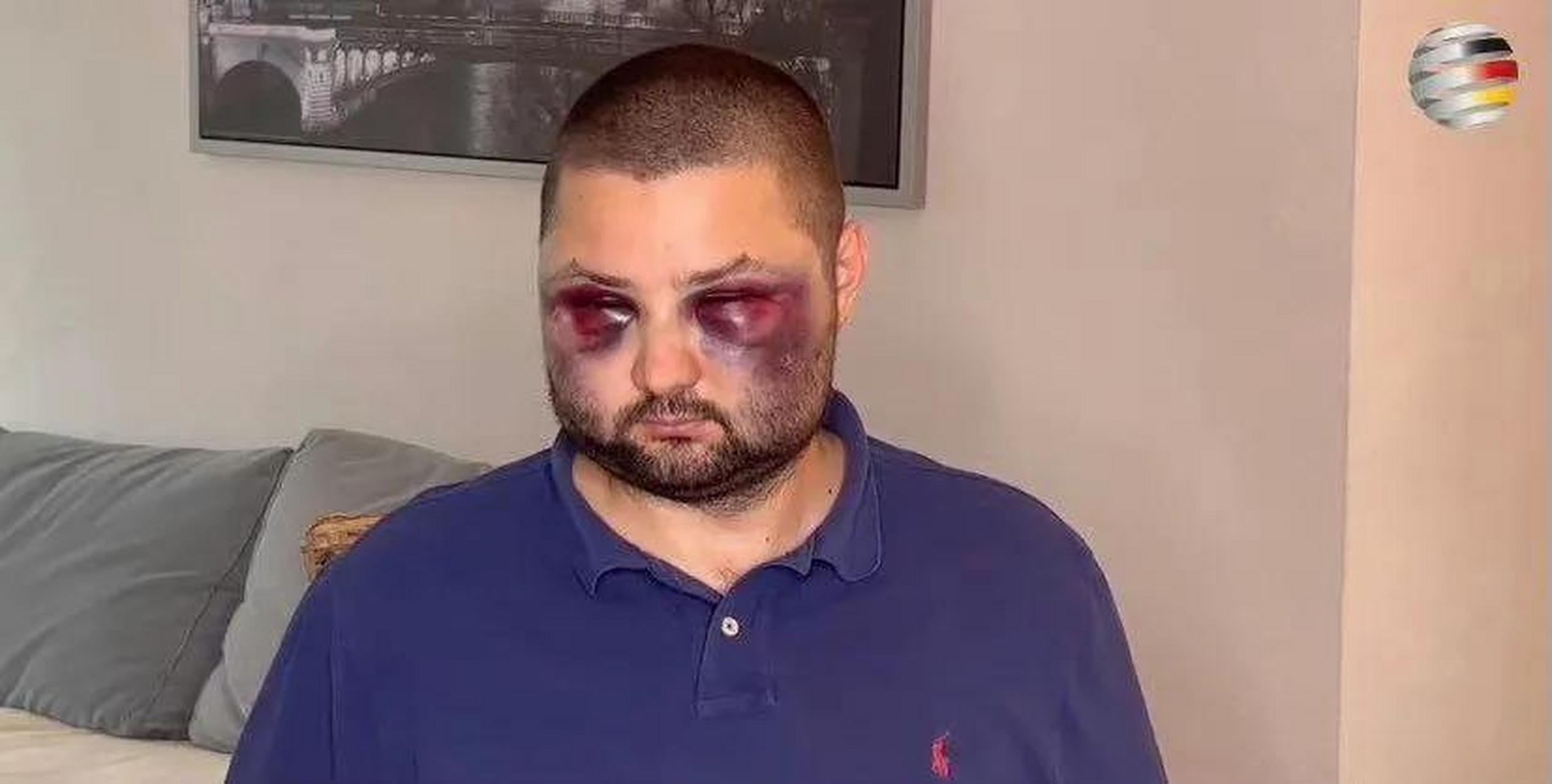 德国一政客遭难民毒打  德国一政客被移民打到鼻青脸肿 据德国媒体