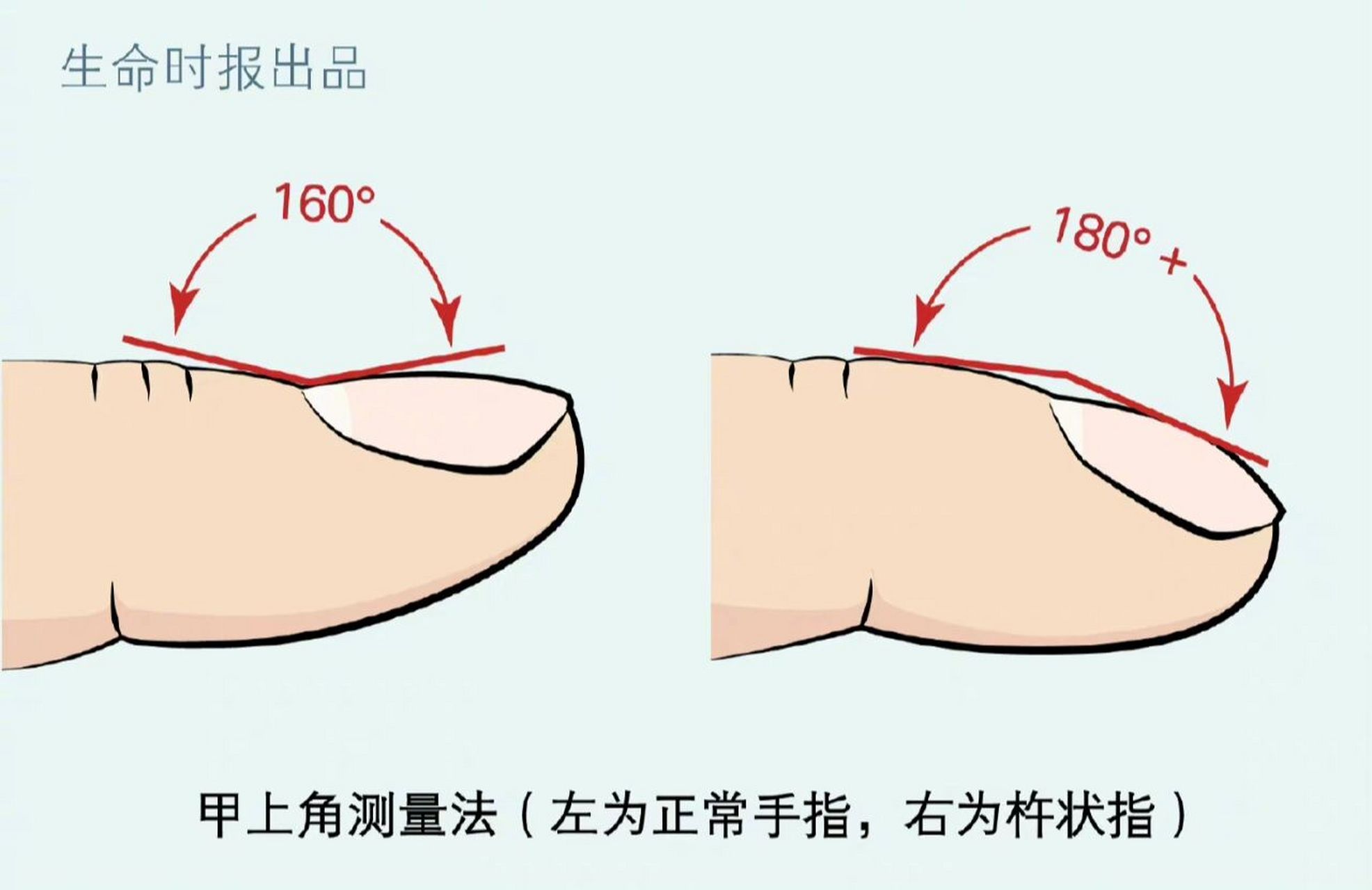 3种方法自测杵状指 手指末端肿大,医学术语叫杵状指.