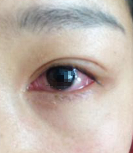摘完美瞳眼睛有红血丝怎么回事?