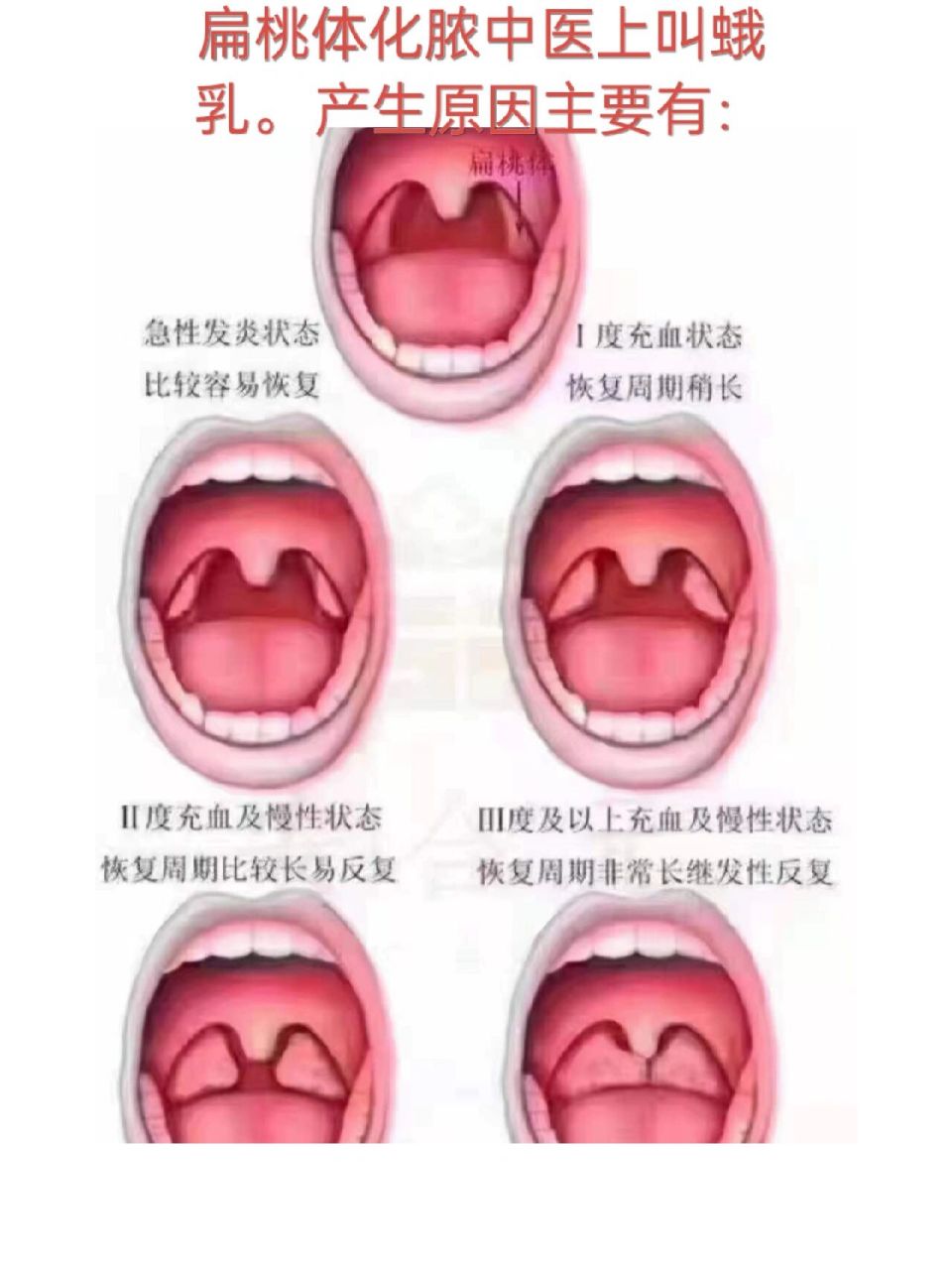 扁桃体化脓中医上叫乳蛾.