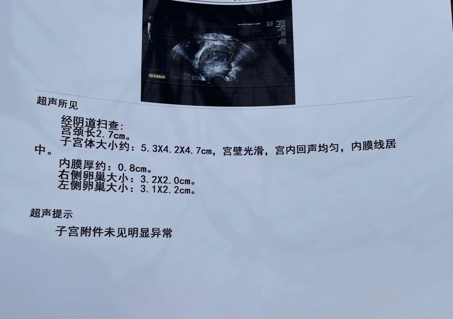 出血20天淋漓不盡 刮宮了 接上篇,喝了止血藥,血少了流褐色兩天又白帶