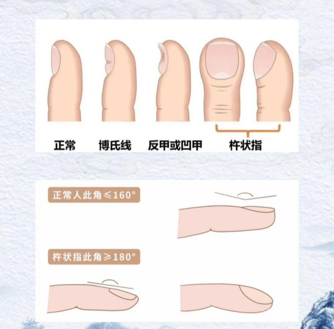 杵状指,又称为鼓棰指,是指指端呈现出增厚,变圆,指甲变拱向上弯曲的