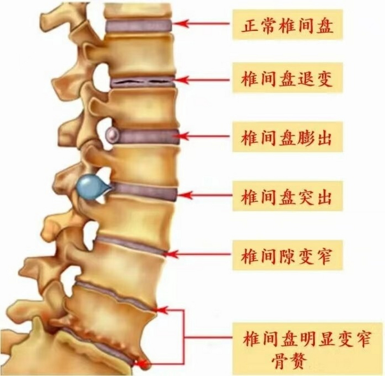 椎板间隙图片