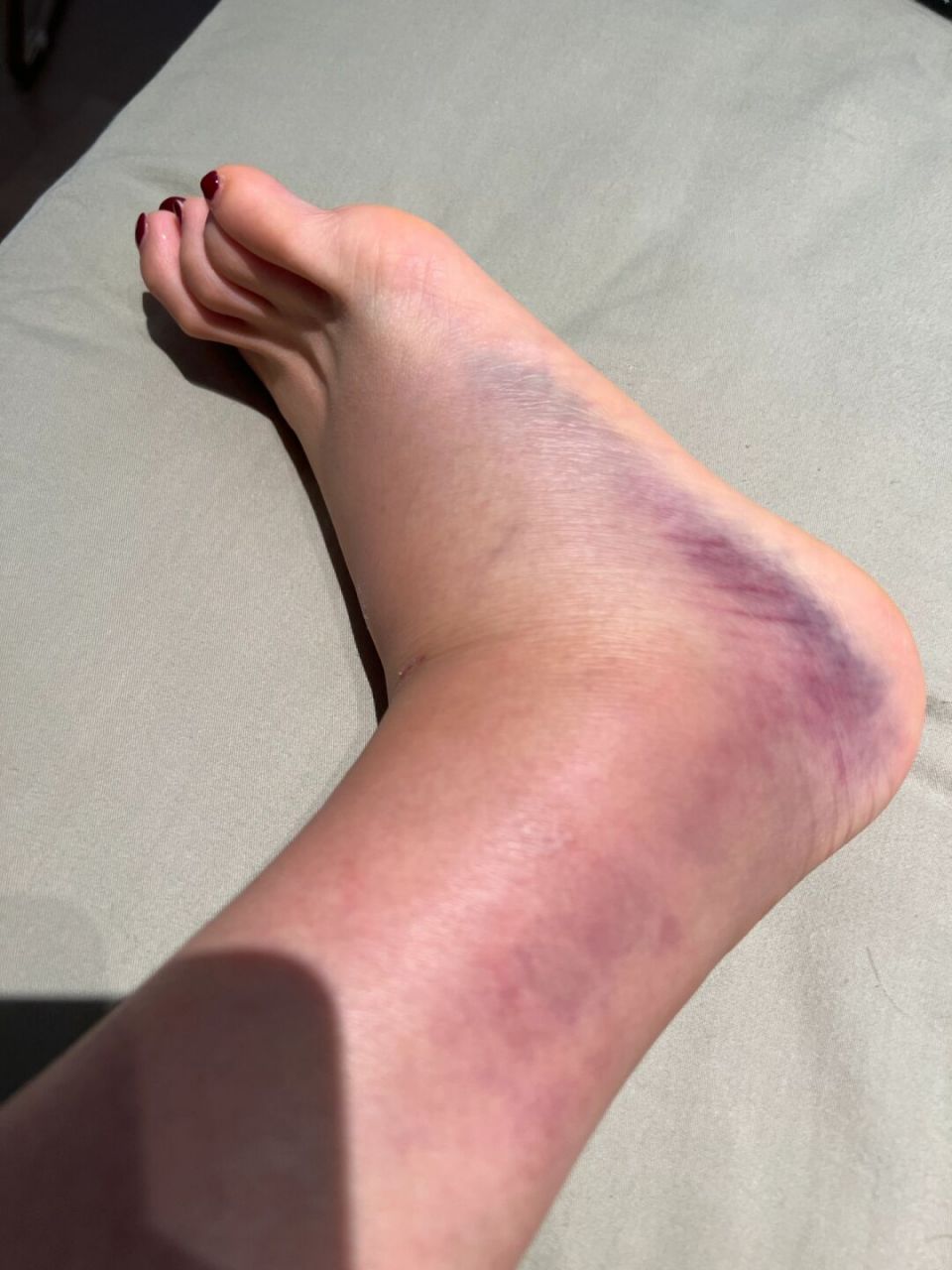 崴脚第三天 拍了片子骨头没事…啥时候能好啊?