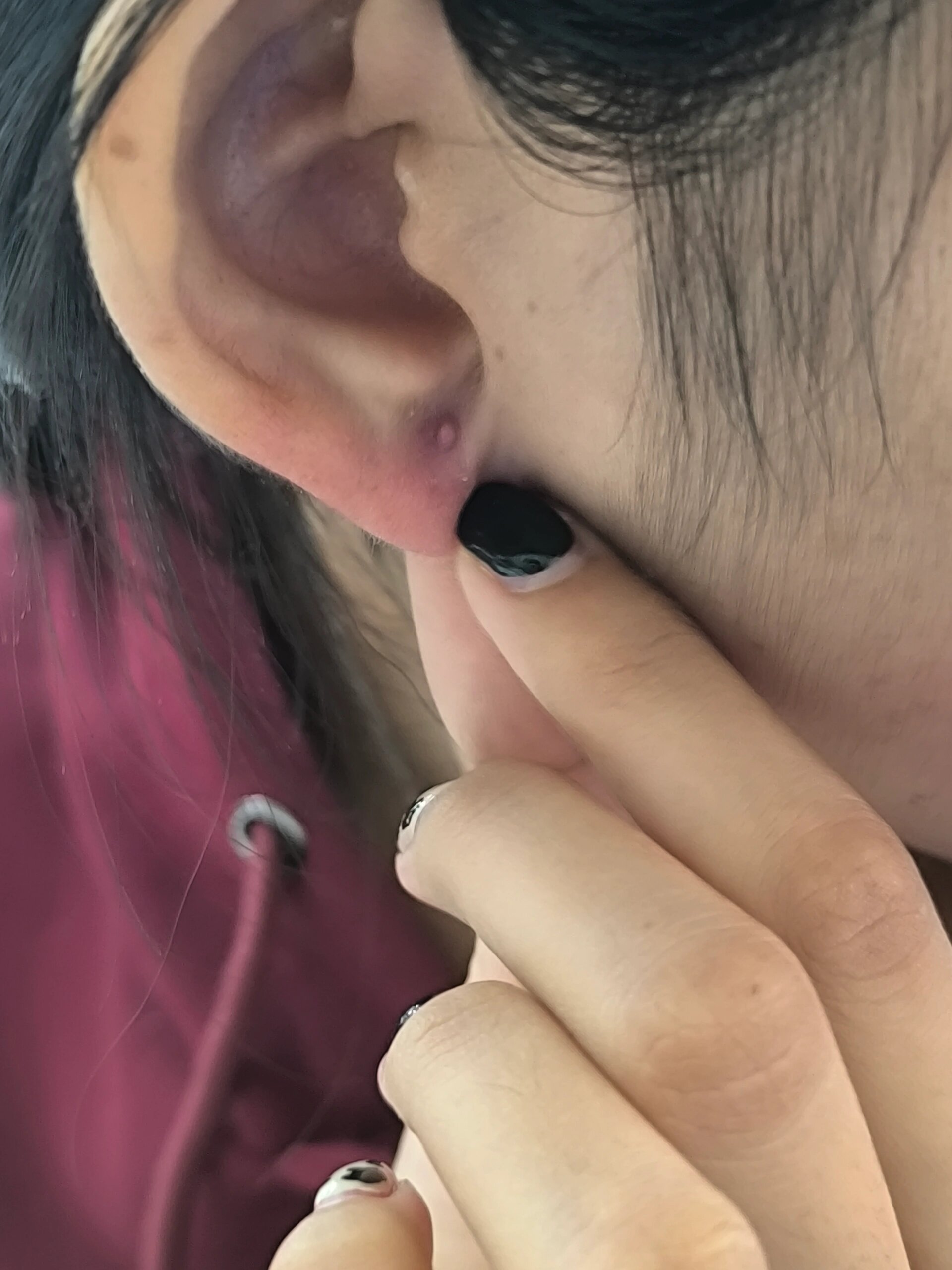 耳洞旁边长了个小疙瘩