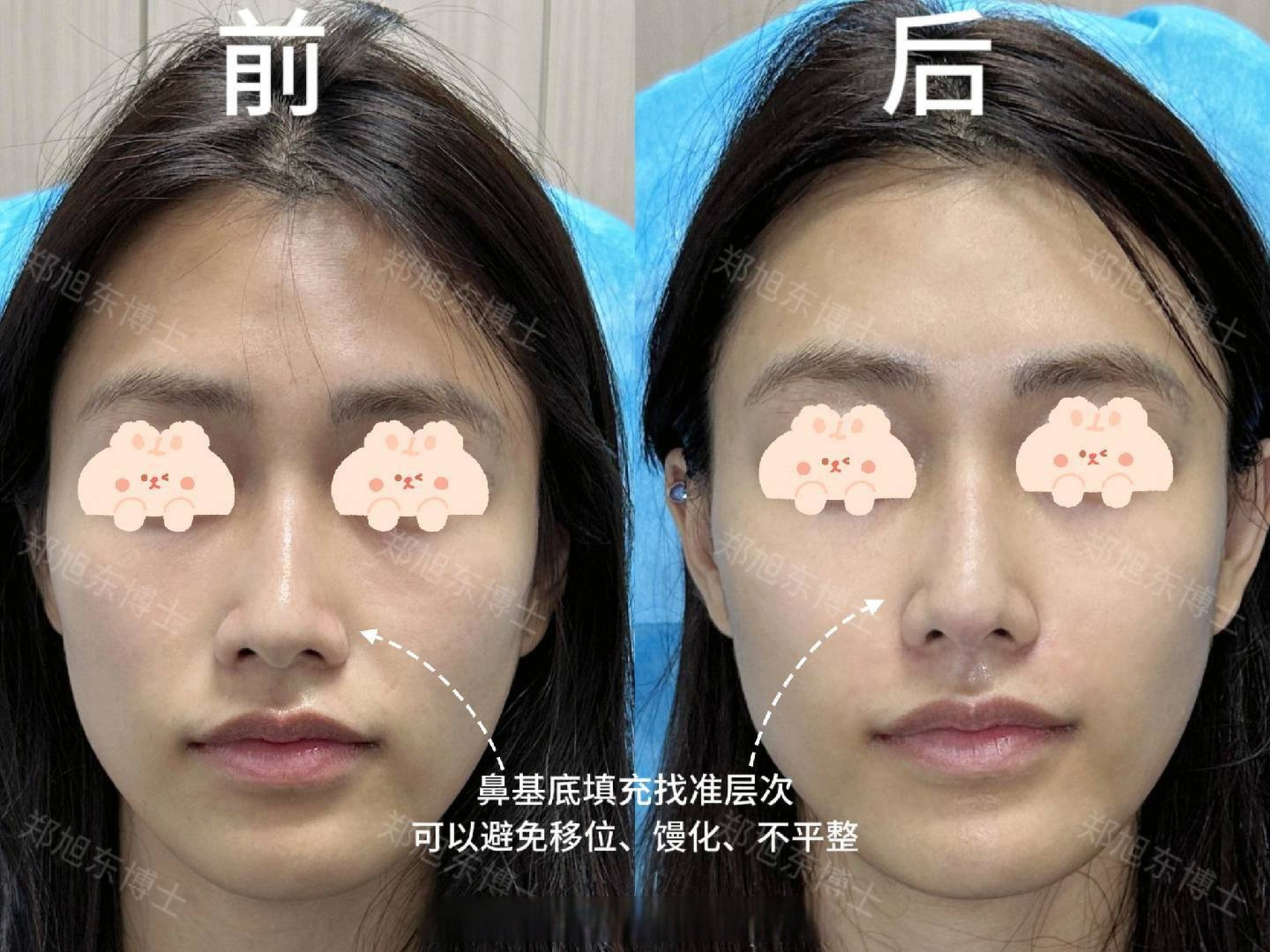 案例分享  求美者鼻基底凹陷,鼻梁高挺却鼻根稍细,有驼峰.