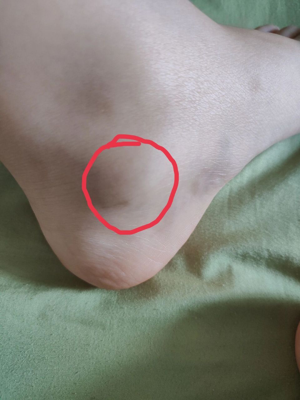 左脚后跟内侧下面的骨头突然异常突出 不痛不痒,看起来有点畸形,有点