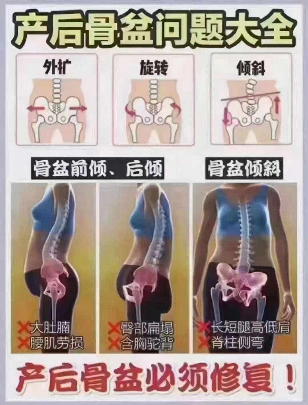 骨盆后倾的危害图片