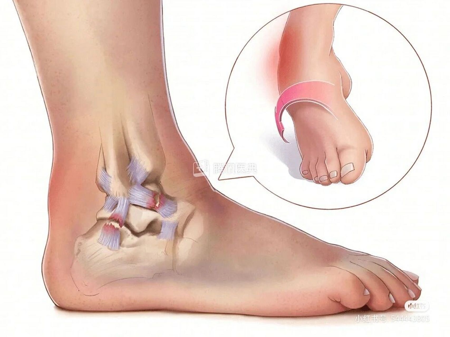 踝关节损伤求推荐医院 崴脚一年了还是疼,韧带断裂,软骨损伤,日常走路