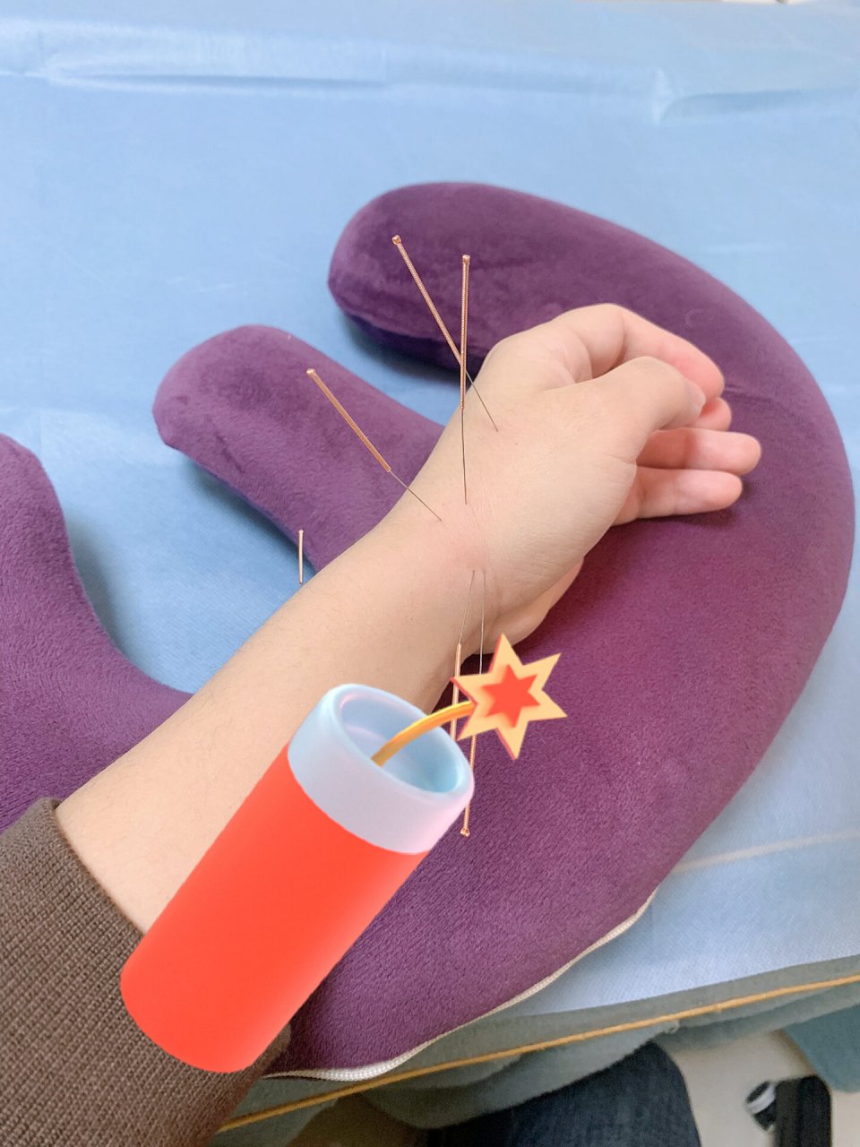 腱鞘炎治疗中 想赶在年前好转些 第二次针灸 扎进去还是挺疼的.