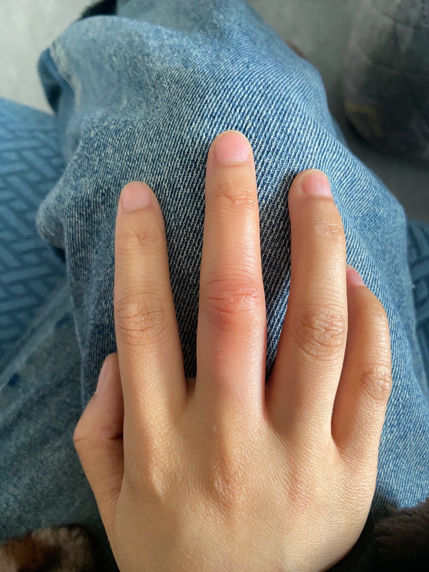 手指这两个关节突然又肿又痒