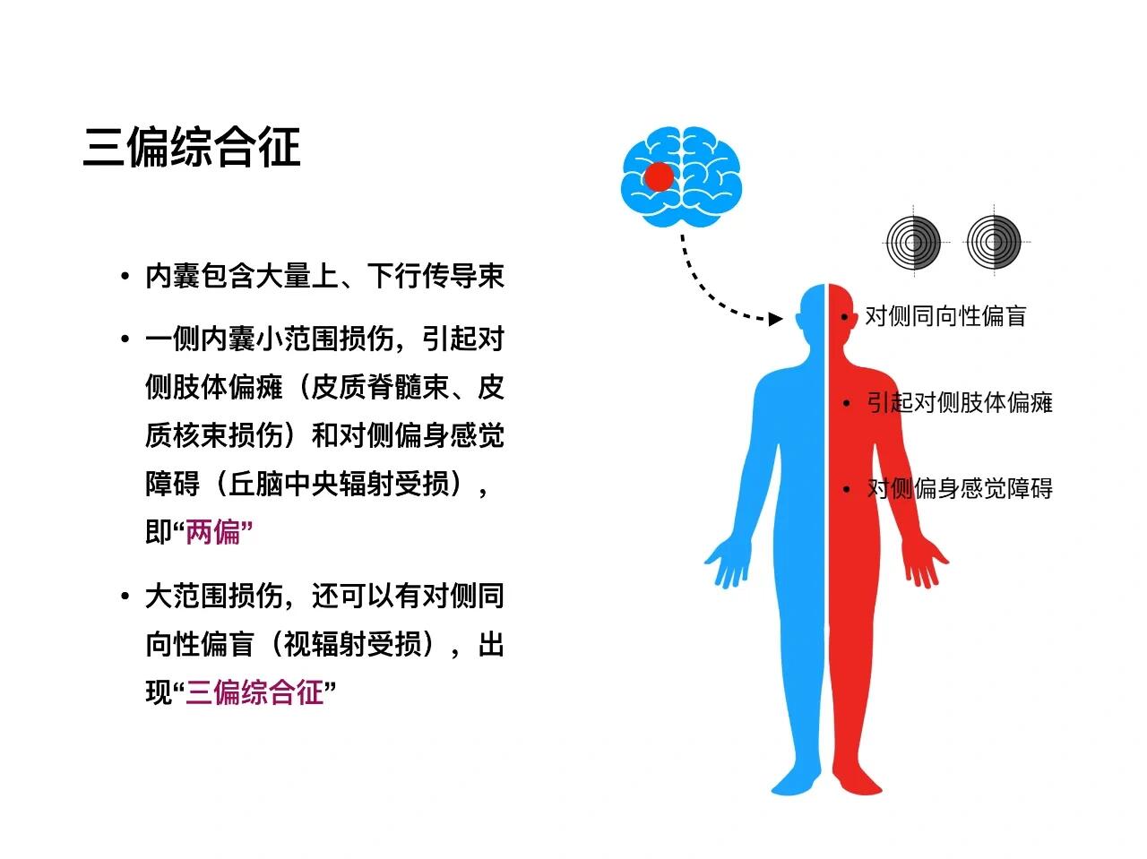 右侧偏盲图片