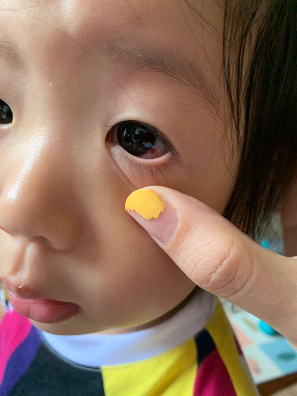 被同龄小朋友戳到眼睛膜下出血00 小朋友一起玩磕碰是难免的,但是