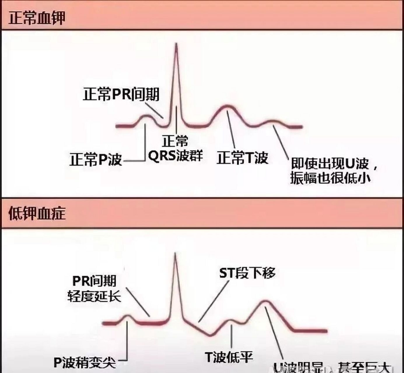 低血钾的心电图波形图片