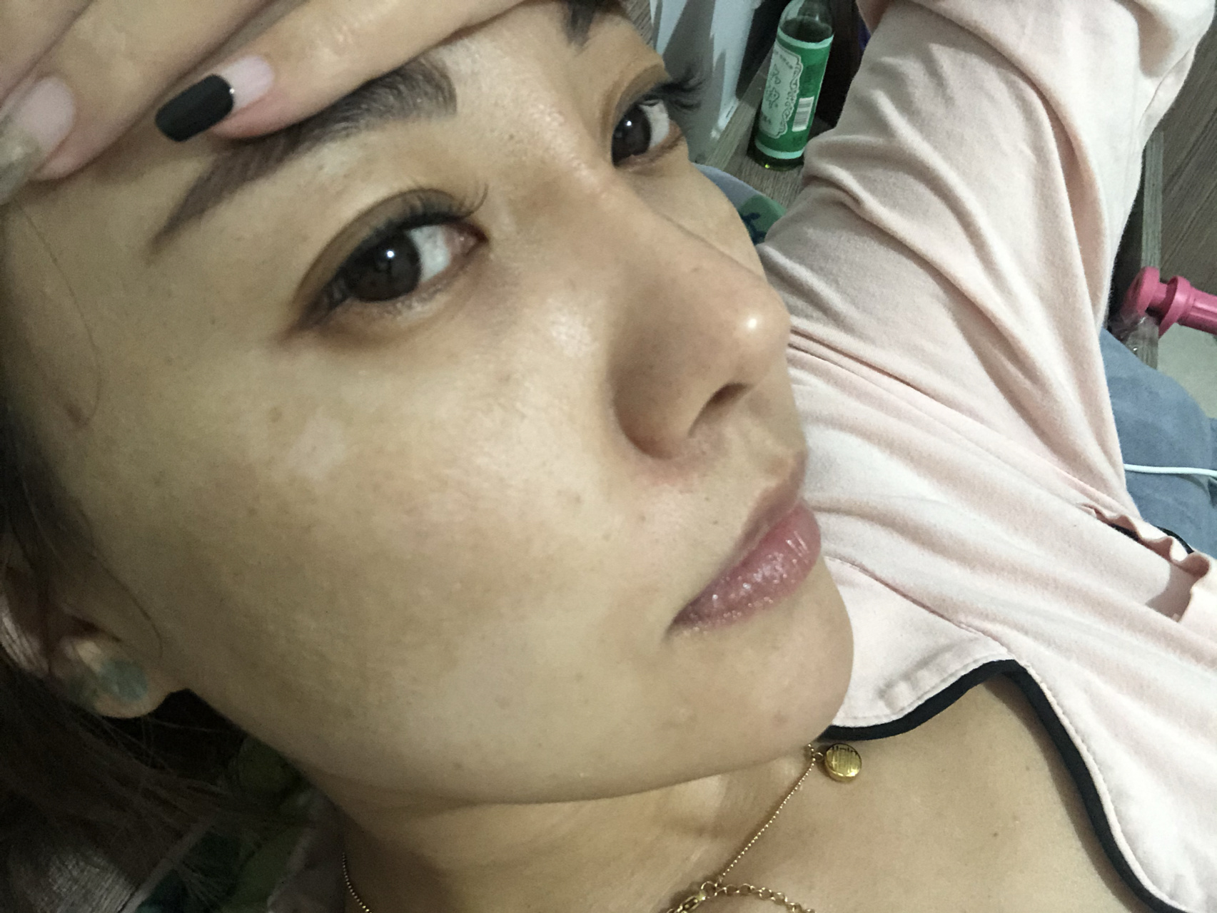 氨甲环酸治疗黄褐斑十一天 做皮秒激发出了大片黄褐斑 氨甲环酸内服