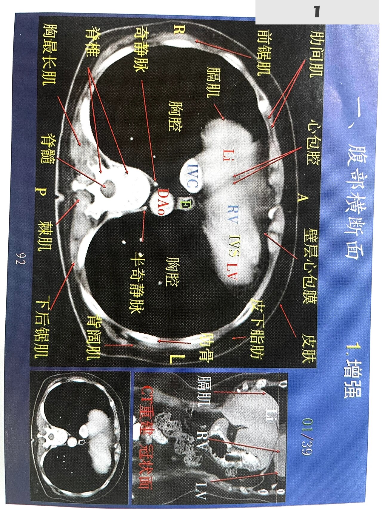 胆总管ct正常图解图片