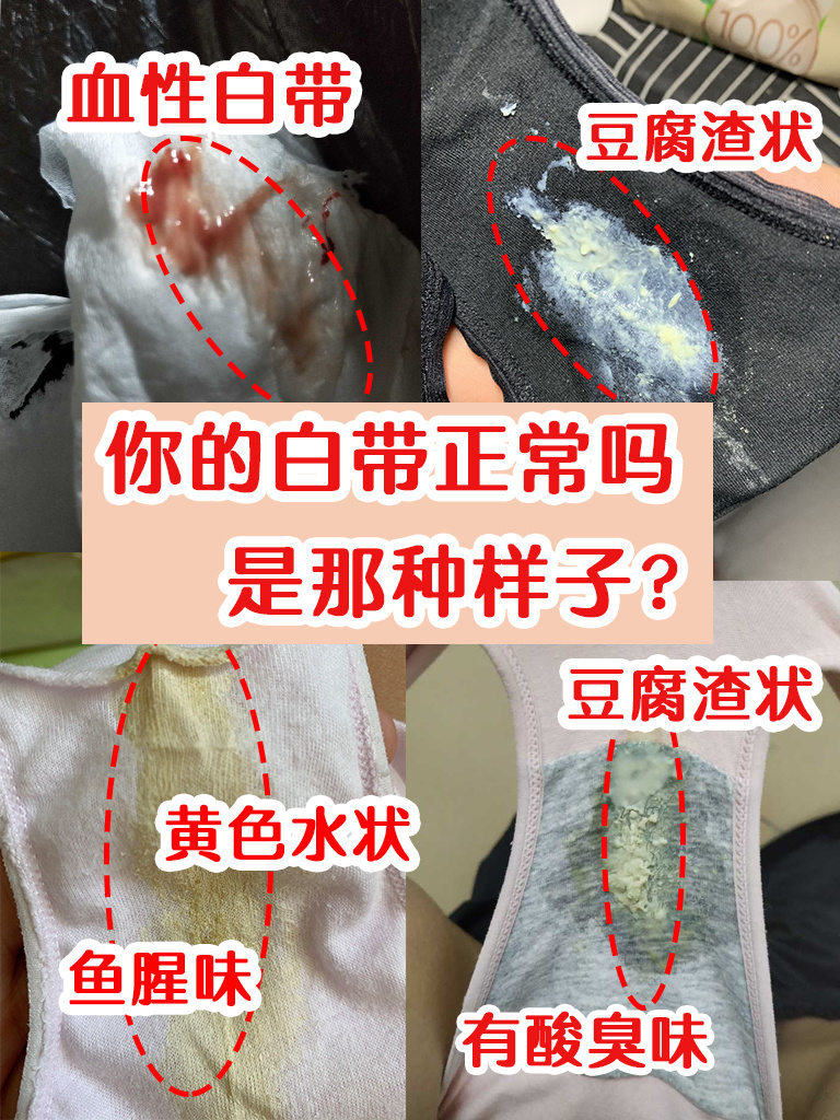 炎症 🎀从去年8月开始,白带一直不正常,是黄色的脓性,有的还是豆腐