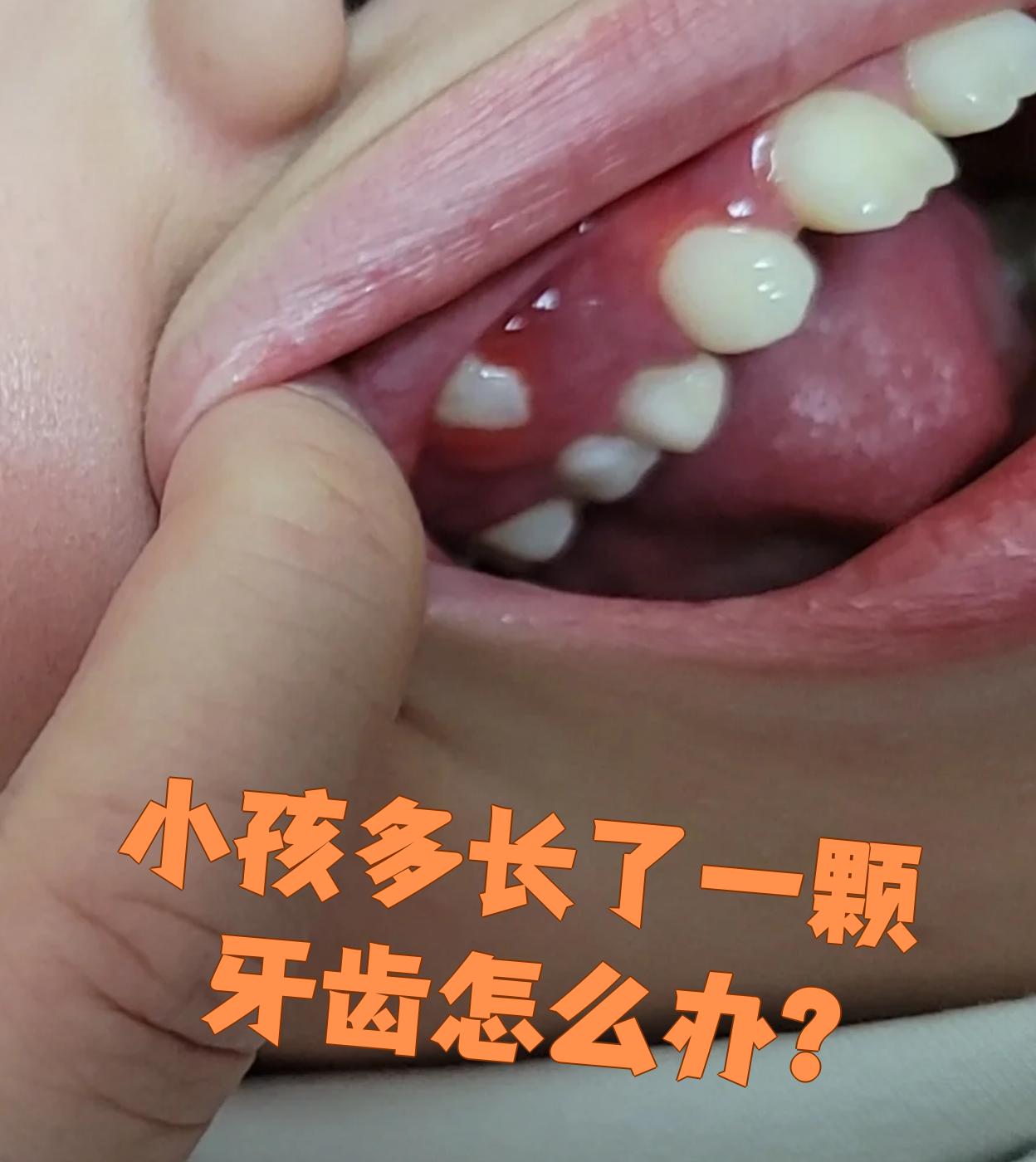小孩多长了一颗牙齿怎么办?