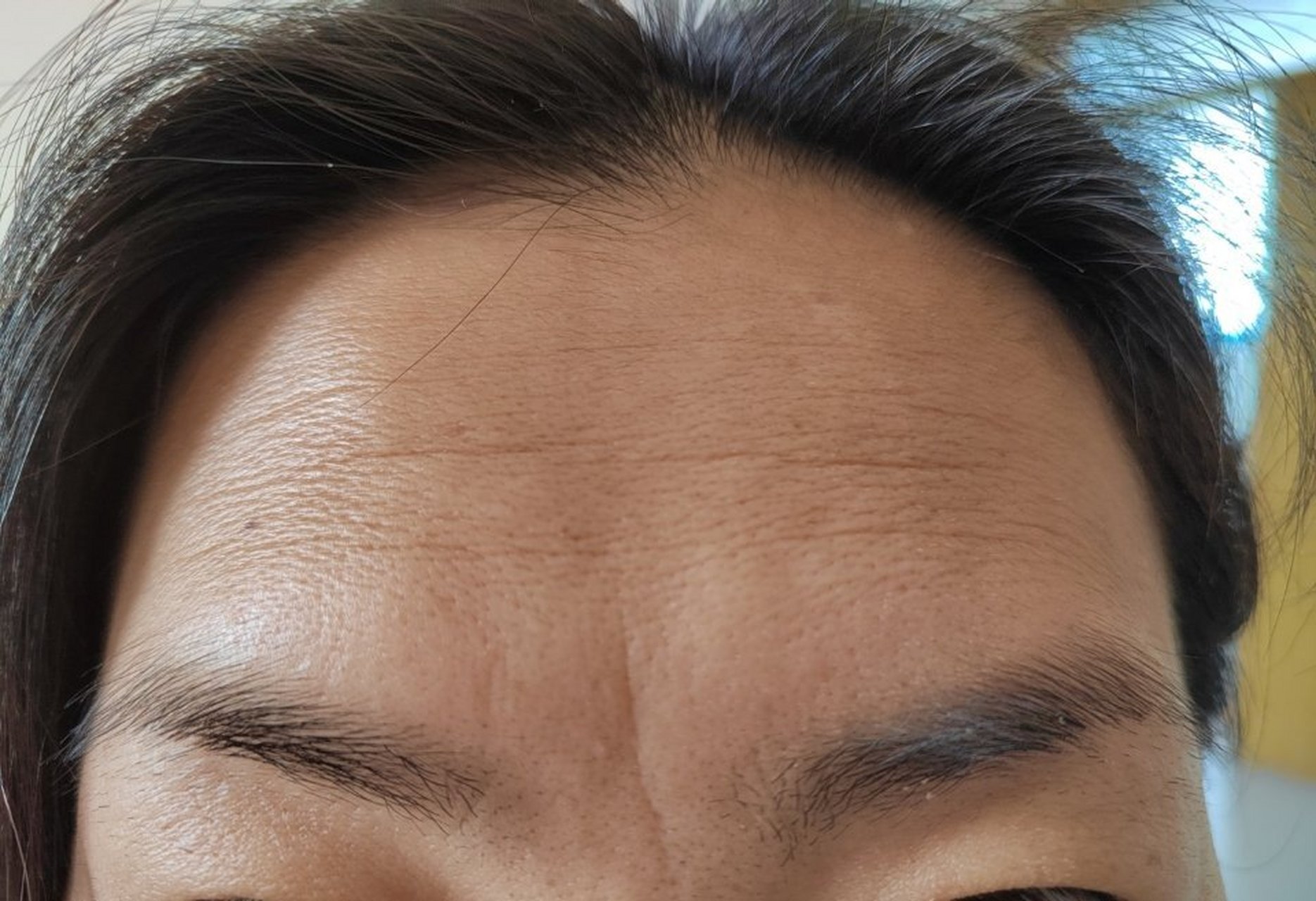 面部眉间纹抬头纹眼角纹鼻背纹颈纹都是可以治疗的.肉毒素注射配合激