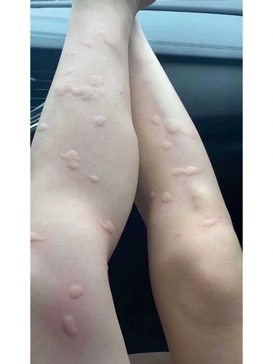 密集恐惧症患者 轻易不要点开看 尤其图片不要放大看 看得起一身鸡皮