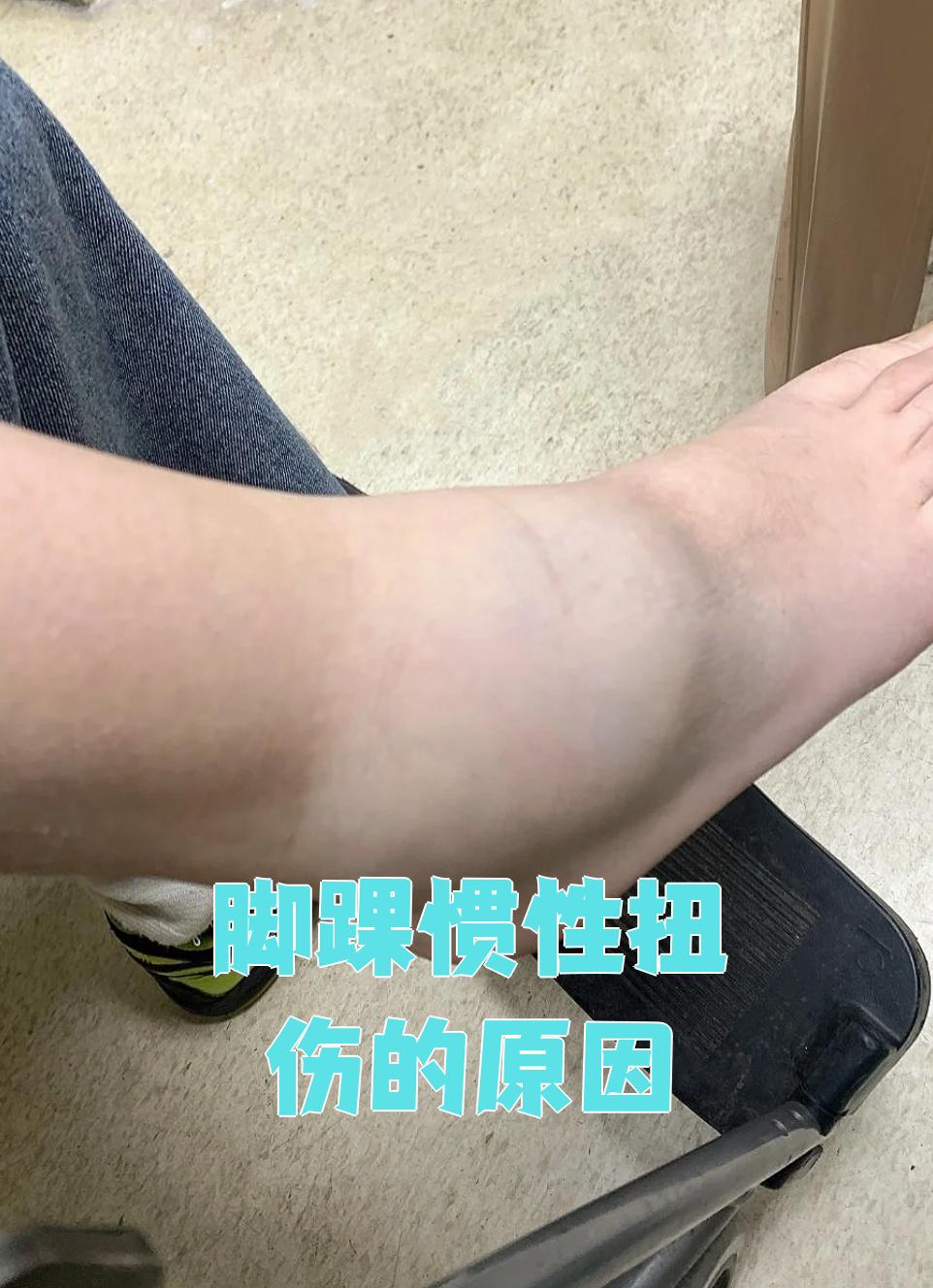 脚踝惯性扭伤指的是同一个脚踝反复发生扭伤