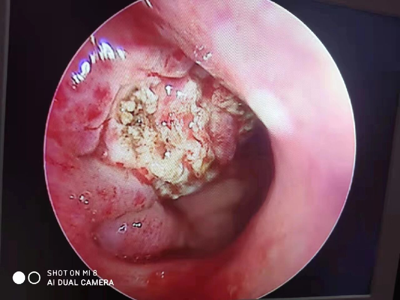腺样体肥大,前后对比