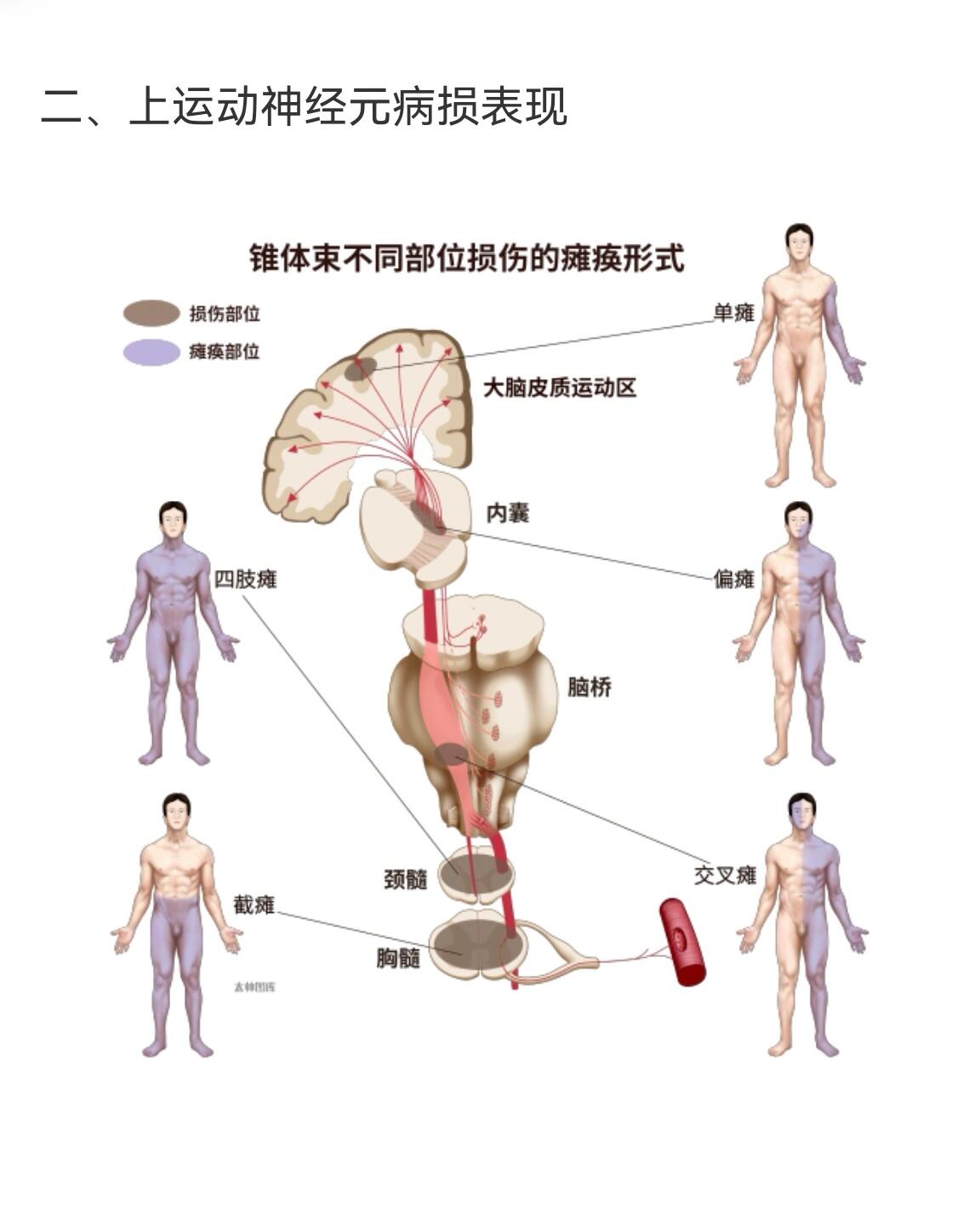 上运动神经元瘫痪图片