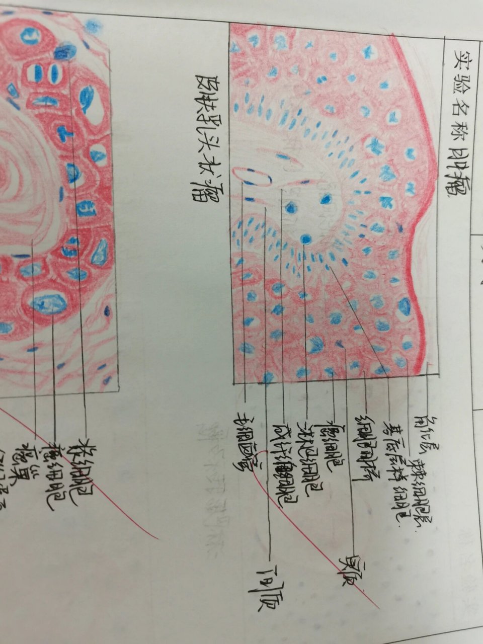 病理肿瘤红蓝铅笔图 皮肤乳头状瘤 高分化鳞状细胞癌 淋巴结转移癌