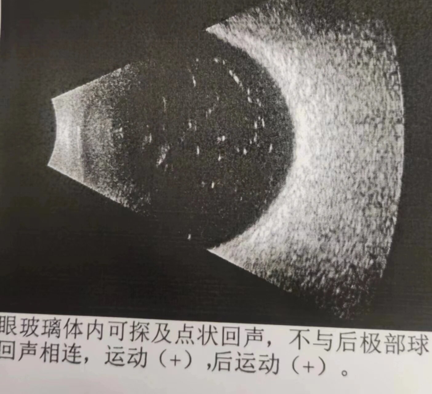 不用散瞳的眼底检查