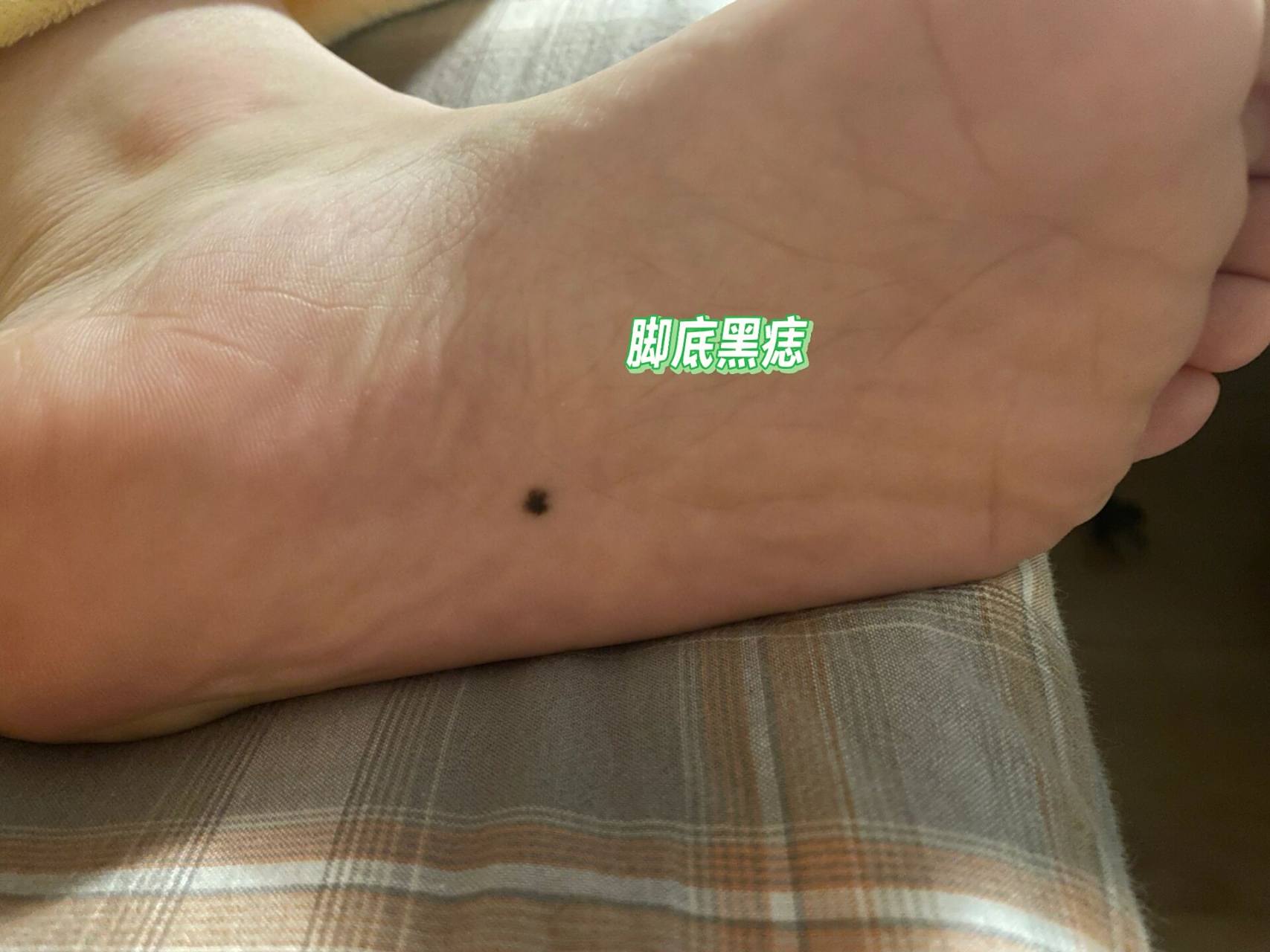 脚底黑痣 我的脚底痣应该长了有小10年了,之前从未在意,且有种迷信