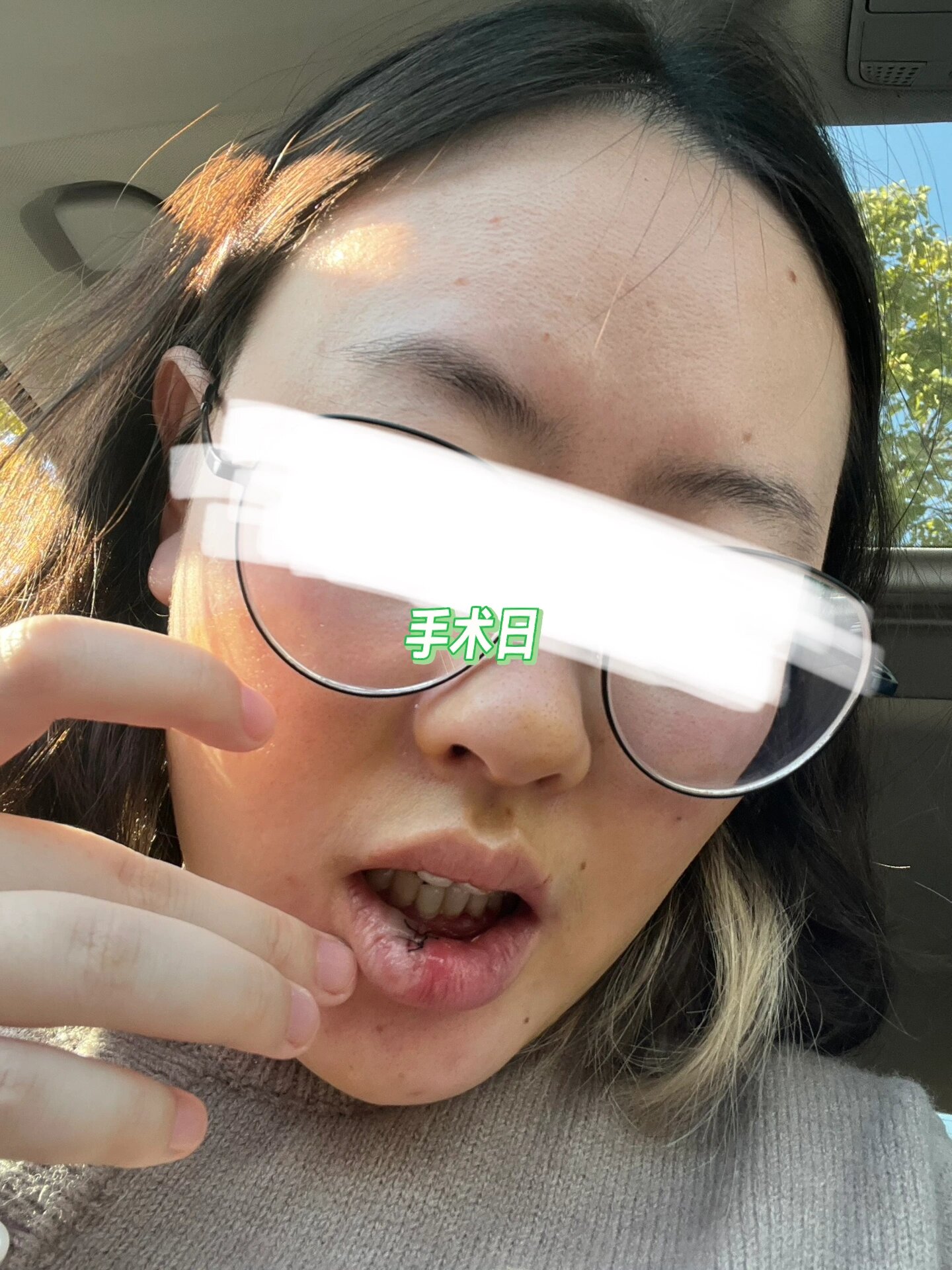 经验分享 | 粘液腺囊肿手术 和同样有粘液腺囊肿困扰的友友们 分享