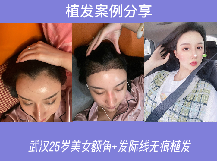 哪儿做植发(哪里做植发好)