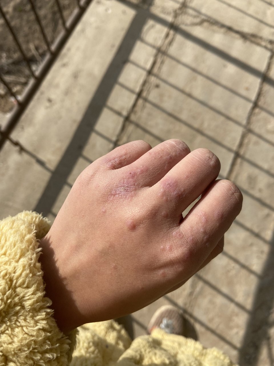 冻疮一个星期好了开心开心96谢谢薯友建议 接上一