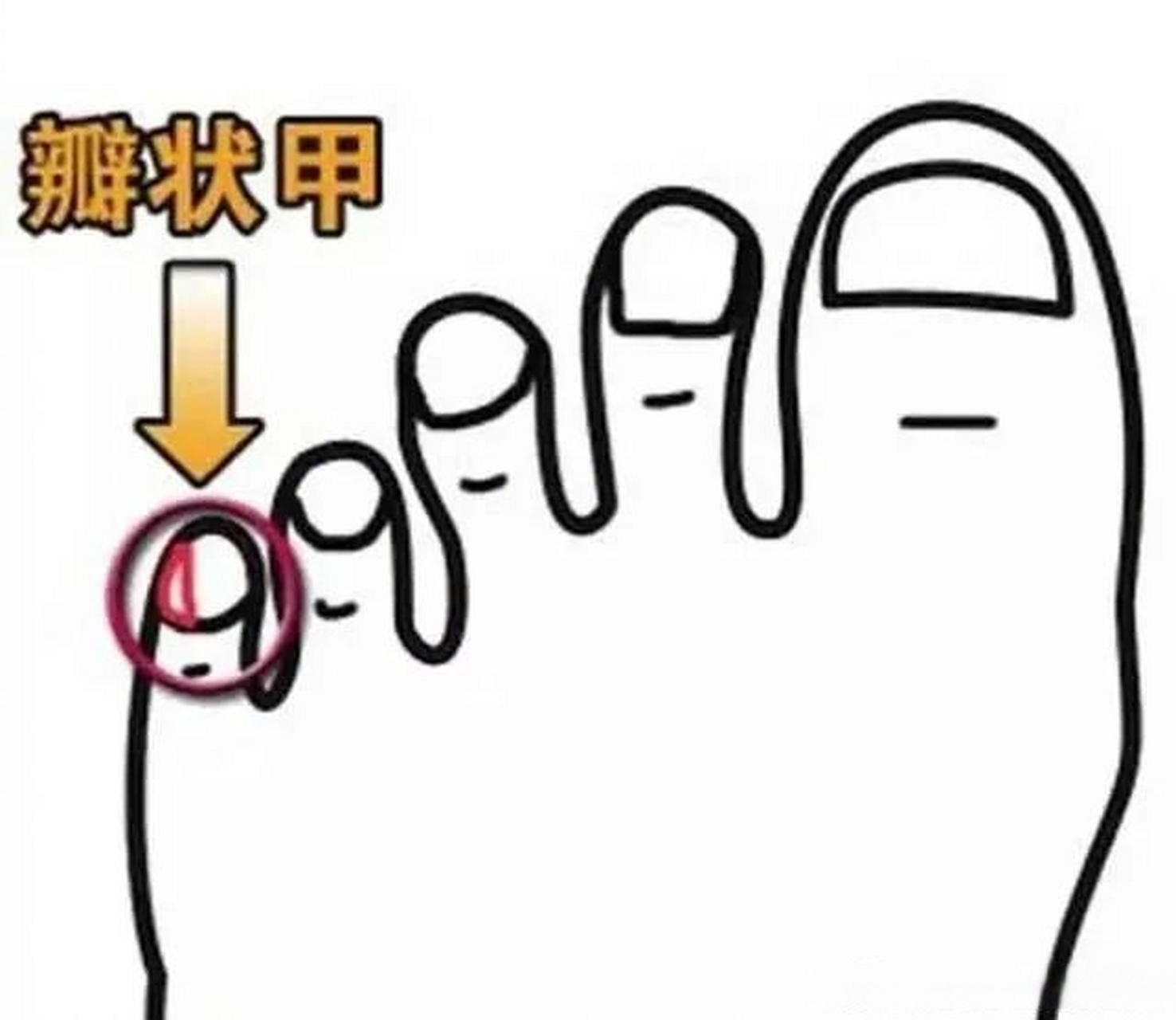 小脚趾甲分成两半这种现象在医学上称为"跰趾"或"瓣状甲".