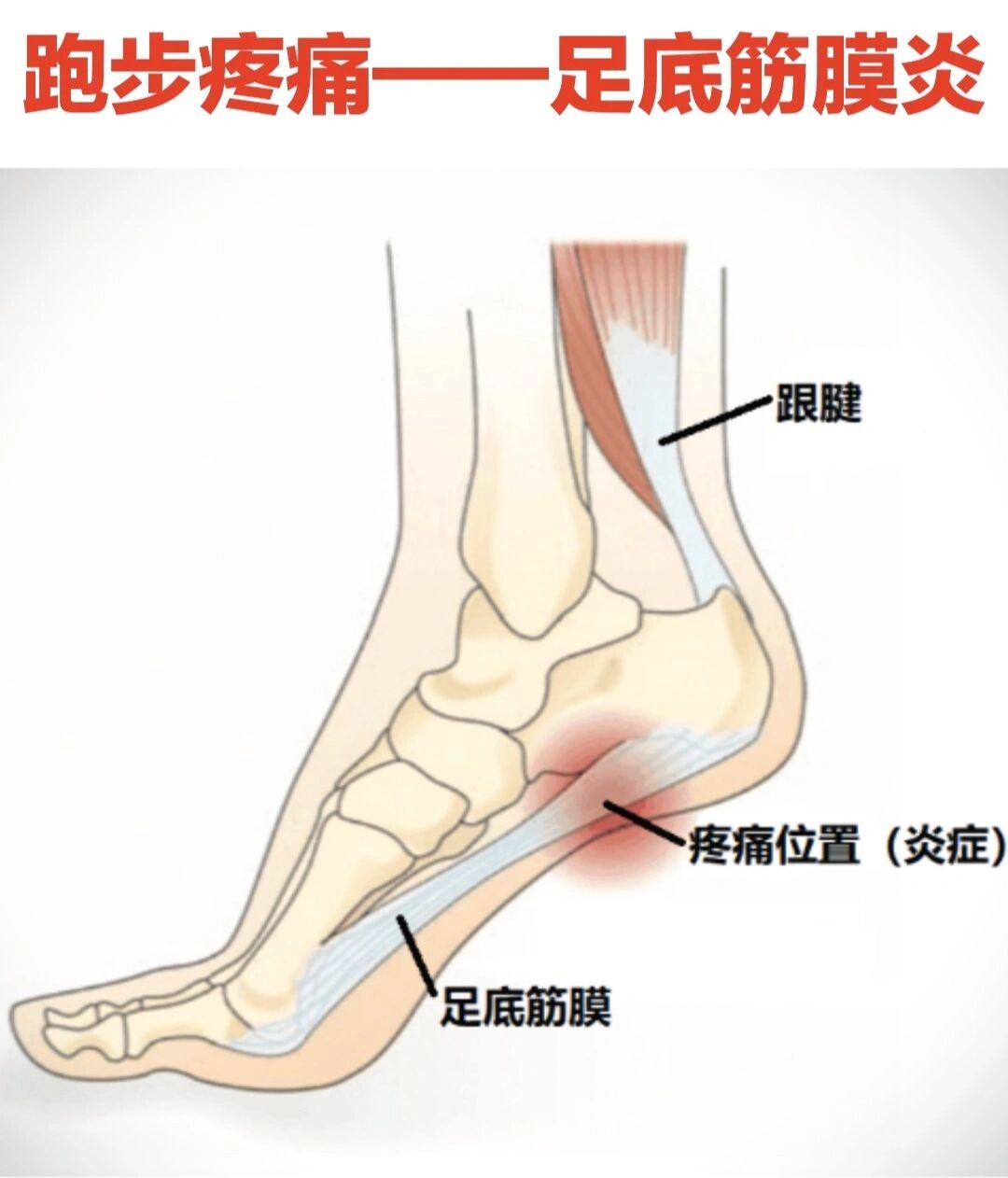 足底筋膜炎解剖图图片