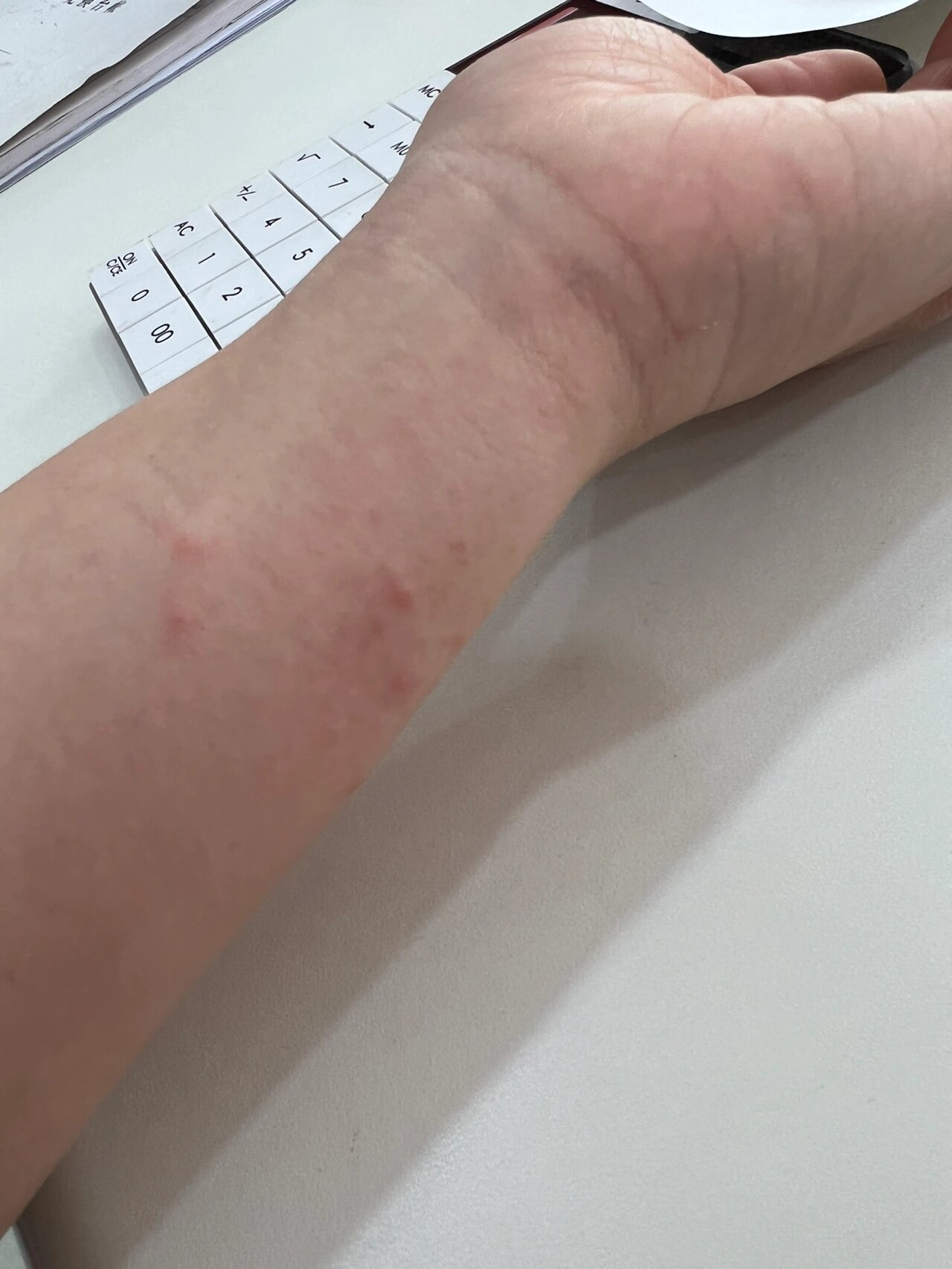 戴手表,手腕过敏.有好的解决办法吗