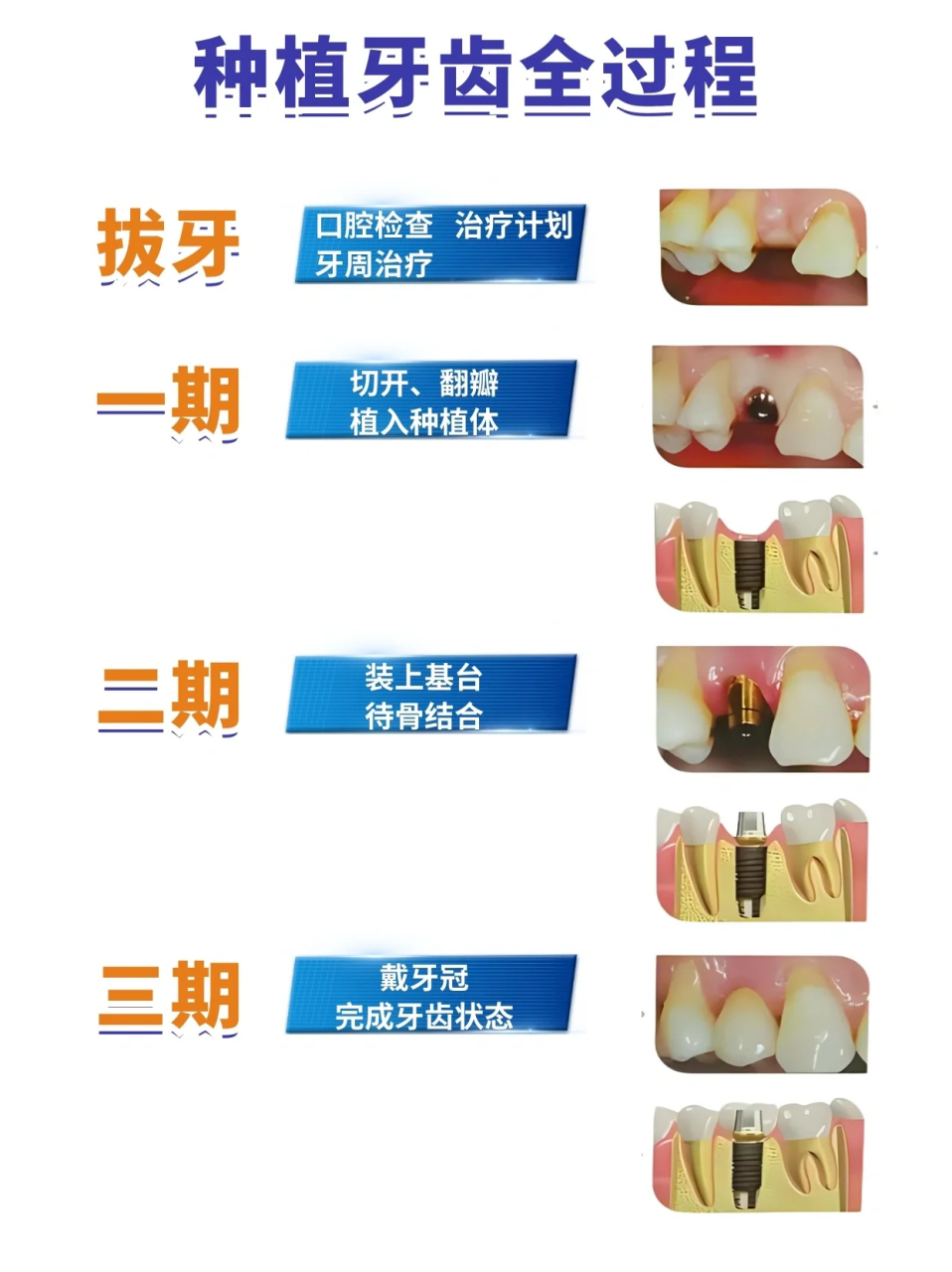 种植牙过程‼️‼️种植牙流程大概分为这三期: