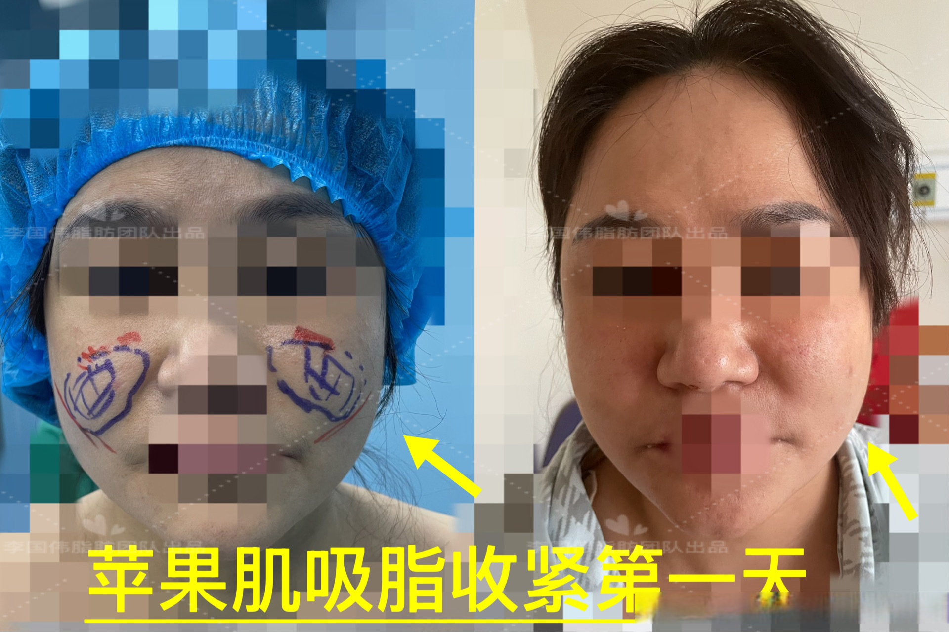 昨天我们分享了来做苹果肌单部位吸脂的姑娘,正好术后第一天来院做