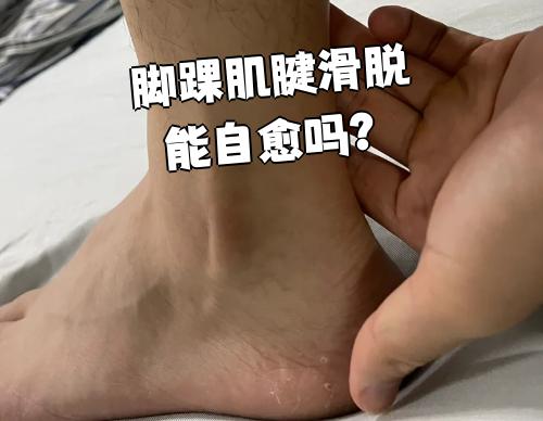 脚踝肌腱滑脱通常不会自己好,一定要及时去医院看,不然可能会越来越