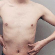 怎样判断男性乳房肥大是脂肪堆积还是乳腺发育