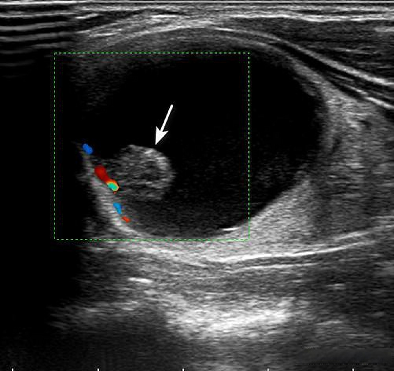 甲状腺囊实性结节如何判断?