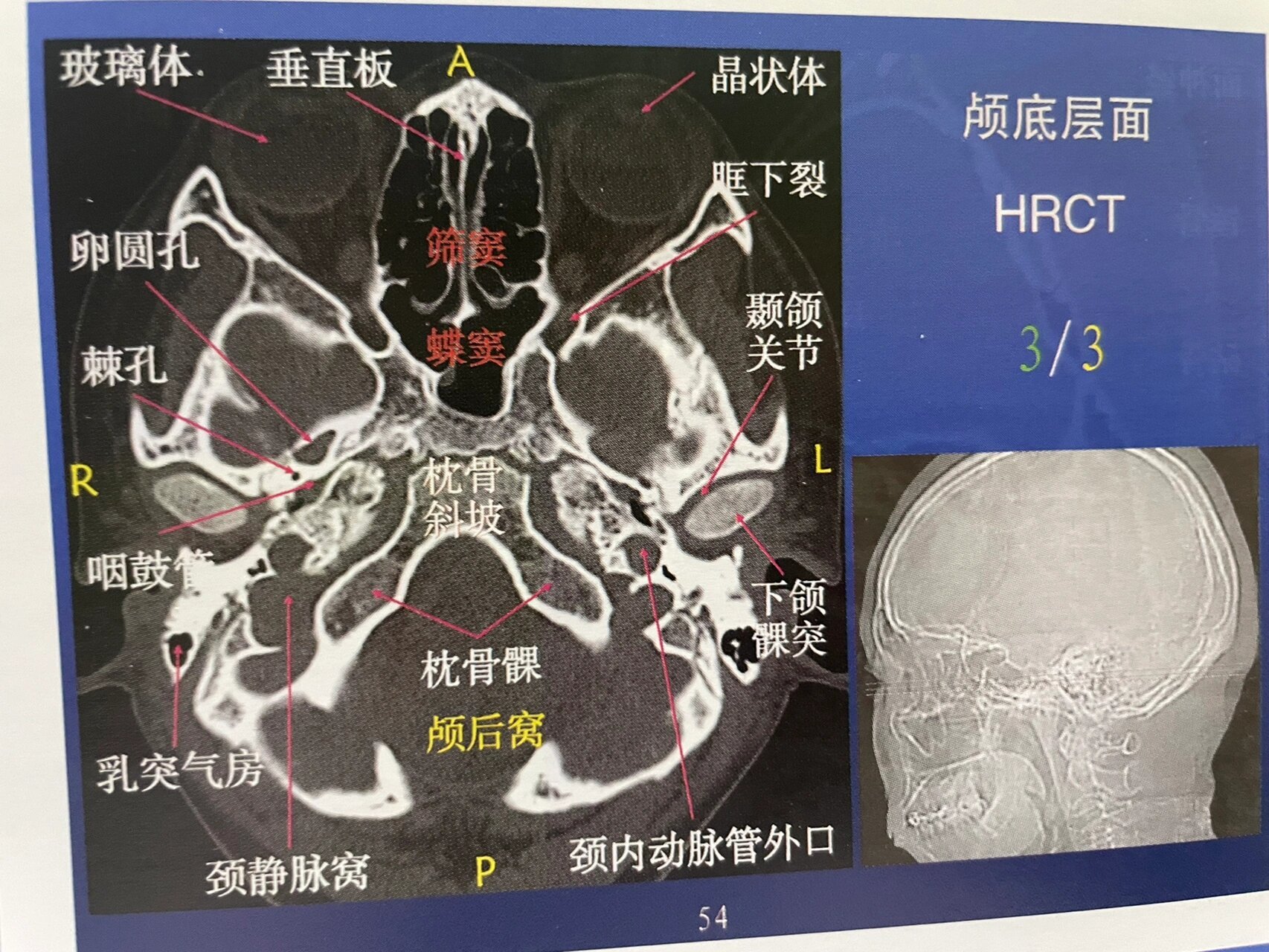 额窦解剖结构图图片