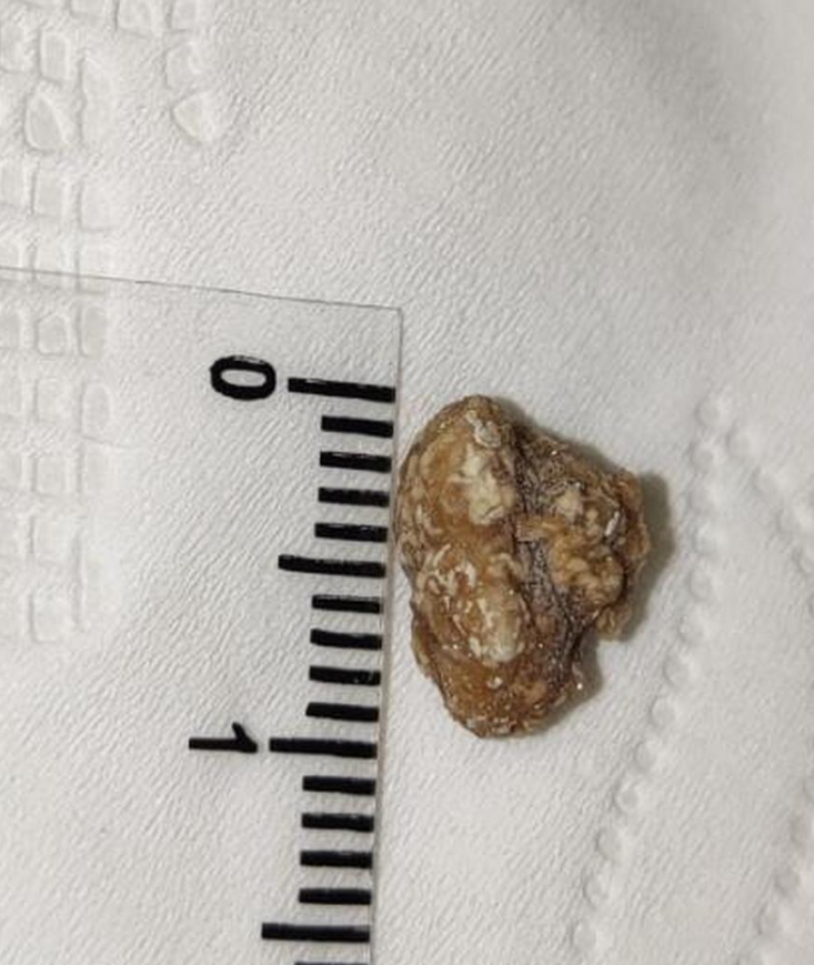 第一种可能是肾结石.肾结石通常和代谢异常或饮食不当有关